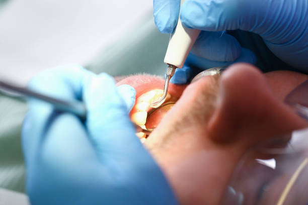 Best Emergency Dental Care for Broken or Chipped Teeth in Goldens Bridge, NY