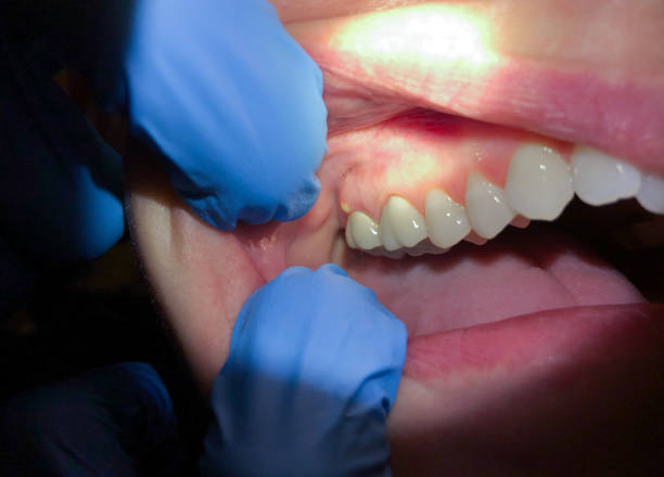 Best Emergency Dental Care for Broken or Chipped Teeth in Goldens Bridge, NY